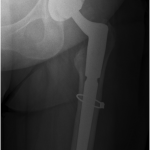 Fig. 4 Six-month postoperative anteroposterior left hip radiograph showing healing of the proximal femoral lesion and stable component positioning.
