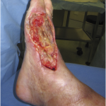 Fig. 1 The postoperative appearance after the third debridement shows the enlarging lesion with exposed bone and tendons.
