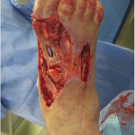 Fig. 2 The postoperative appearance after the fourth debridement shows the exposed implants. Subcutaneous and fascial sutures had fallen apart, and the first metatarsal had been partially resected.
