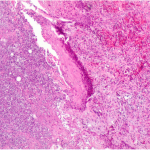 Fig. 3 Stained skin section taken from the wound borders of the foot. The histology shows an unspecific inflammatory reaction with granulation tissue, fibrin, and neutrophil granulocytes (hematoxylin and eosin stain, 40× magnification).
