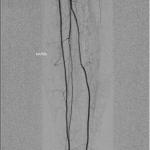 Fig. 4 Fine-needle angiography of the right leg showed a normal vascular supply of the calf and no relevant stenosis.
