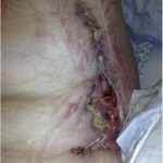 Fig. 5 The donor site of the latissimus dorsi flap also showed ulcerations with undermined borders, surrounded by erythema with a well-defined border and the violaceous and reddish color.
