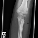 Fig. 1-A Anteroposterior radiograph showing the radial neck fleck sign (arrow).
