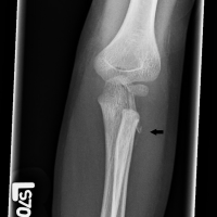 A Three-Year-Old Boy with Elbow Trauma and Abnormal Radiographic Elbow ...