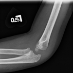 Fig. 1-B Lateral radiograph showing the radial neck fleck sign.
