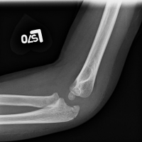 A Three-Year-Old Boy with Elbow Trauma and Abnormal Radiographic Elbow ...