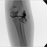 Fig. 2 Arthrogram showing a laterally and distally displaced radial head with 80° of angulation.

