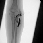 Fig. 4 Repeat arthrogram confirming stabilization of the reduced radial head by the pin.
