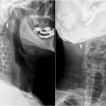 Fig. 1 Preoperative cervical spine radiographs. The lateral (left) radiograph shows the atlantoaxial subluxation (arrow), and the anteroposterior (right) radiograph shows the right-sided tilt of the head (arrow).
