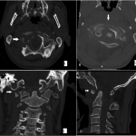 Fig. 2 Cervical spine CT with axial (Figs. 2-A and 2-B), coronal (Fig. 2-C), and sagittal (Fig. 2-D) reconstructions. Figs. 2-A and 2-C show the lytic destruction of the right atlantooccipital joint (arrows). Fig. 2-B shows the lateral right atlantooccipital subluxation (arrow). Fig. 2-D shows the anterior atlantoaxial subluxation (arrow).
