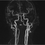 Fig. 4 The magnetic resonance angiogram shows occlusion of the right vertebral artery at the C1 level, with flow of the basilar artery coming from the left vertebral artery (arrow).

