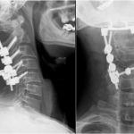 Fig. 5 Postoperative lateral (left) and anteroposterior (right) cervical spine radiographs.
