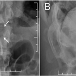 Fig. 1 Anteroposterior (Fig. 1-A) and lateral (Fig. 1-B) radiographs showed a radiolucency (arrows) involving the spinous process of T12.
