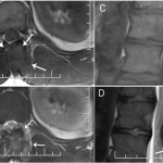 Fig. 2 Figs. 2-A through 2-D Baseline MRI scans at the time of initial clinical presentation showed an expansile lesion (arrows) involving the posterior elements, which was centered in the spinous process of T12. Both axial and sagittal views are provided. Fig. 2-A T1-weighted axial view (TR 600, TE 9.5). Fig. 2-B T2-weighted axial view (TR 2930, TE 103). Fig. 2-C T1-weighted sagittal view (TR 600, TE 9.3). Fig. 2-D T2-weighted sagittal view (TR 2200, TE 96).
