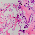 Fig. 5 Low (Fig. 5-A) and high (Fig. 5-B) magnification of the tumor, which is composed of irregularly shaped woven bone trabeculae with osteoblastic rimming and highly vascularized loose stroma (hematoxylin and eosin stain, 200× and 400× magnification, respectively).
