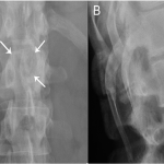 Fig. 6 Five years and four months after the initial presentation, anteroposterior (Fig. 6-A) and lateral (Fig. 6-B) radiographs of the lower thoracic spine show a similar radiolucency (arrows) in the T12 spinous process as was seen in the initial radiographs (see Fig. 1).
