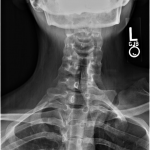 Fig. 2-A Anteroposterior cervical spine radiograph.
