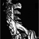 Fig. 2-C Shoulder CT scan with three-dimensional reconstruction: lateral view.
