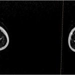 Fig. 3-A Axial T1-weighted MRI scan showing a soft-tissue mass with intermediate signal adjacent to the cortex of the distal part of the left tibia that does not appear to violate the cortex.
