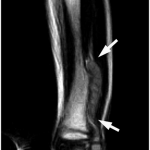 Fig. 3-B Coronal T1-weighted MRI scan showing a large, somewhat heterogeneous soft-tissue mass (arrow) with intermediate signal adjacent to the lateral cortex of the distal part of the left tibia.
