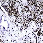 Fig. 4 Photomicrograph of immunohistochemical analysis exhibits a strong nuclear staining with Sox9, which stains primitive cartilage.
