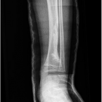 Fig. 5 First postoperative anteroposterior radiograph of the left leg showing the area of resection and bone-grafting in the lateral portion of the distal part of the tibia.
