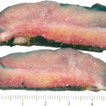 Fig. 6 Surgical specimen cut longitudinally (green ink marks the surface) showing a fleshy-appearing tumor emanating from the surface of the bone; no conclusive permeation into cancellous medullary bone was noted.
