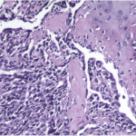 Fig. 7-B A photomicrograph illustrating the biphasic component of mesenchymal chondrosarcoma. In the upper half of the image, there is well-differentiated hyaline cartilage, while in the lower half, there is an undifferentiated small cell component (hematoxylin and eosin, ×120).
