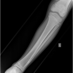 Fig. 8 Anteroposterior radiograph of the left tibia fifty-seven months postoperatively showing incorporation of allograft bone and no evidence of recurrent tumor. The small area of sclerosis in the lateral part of the tibia is a stable postoperative finding.
