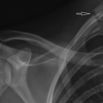 Fig. 1 Posteroanterior radiograph of the right shoulder. The arrow points to the first rib.
