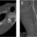 Fig. 2 Figs. 2-A and 2-B CTA images. Fig. 2-A Axial CTA image of the subclavian artery (arrowhead) at the level of the costoclavicular interval (arrow). The asterisk (*) indicates the clavicle, and the x indicates the distal fragment of the first rib. Fig. 2-B Coronal CTA reconstruction of the course of the right subclavian artery showing stenosis at the costoclavicular interval (arrow).
