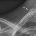 Fig. 4 Posteroanterior radiograph of the right shoulder demonstrating a healed first-rib fracture (arrow) with osseous bridging and extensive callus formation.
