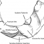 Fig. 5 Line drawing of the cephalad surface of the first rib showing the insertions of the scalene muscles. The fracture site in this case is indicated by the line through the rib at the level of the middle scalene insertion.
