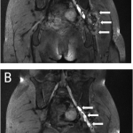 Fig. 1 T2-weighted coronal MRI (three-dimensional diffusion-weighted sequence based on reversed fast imaging with steady-state precession) demonstrating a soft-tissue mass involving the left sciatic nerve (arrows) (Fig. 1-A); edema and thickening of the sciatic nerve are visible (arrows) (Fig. 1-B).
