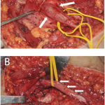 Fig. 2 Figs. 2-A and 2-B Intraoperative photographs. Fig. 2-A The arrows point to the sciatic nerve. Fig. 2-B The arrows point to the circumferential neurolysis of the sciatic nerve.
