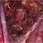 Fig. 3 Laparoscopic view of the endopelvic endometriotic lesion involving the sciatic nerve. LEIA = left external iliac artery, LEIV = left external iliac vein, LON = left obturator nerve (arrow), LIOM = left internal obturator muscle, UB = urinary bladder, LIIA = left internal iliac artery, LU = left ureter, LSN = left sciatic nerve, and EEL = endopelvic endometriotic lesion.
