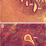 Fig. 4 Histology of the endometriosis of the sciatic nerve (Fig. 4-A) and the obturator lymph nodes (Fig. 4-B), showing ectopic endometrial-type epithelium (arrows) (hematoxylin and eosin stain, 40× magnification).
