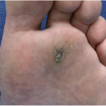 Fig. 1 Clinical photograph showing the lesion at the head of the second metatarsal. There is a rough uneven surface with gray-tan discoloration.
