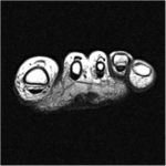 Fig. 2-B Axial T2-weighted MRI revealing a T1-hypointense, T2-enhancing lesion in the subcutaneous tissue on the plantar aspect of the second and third metatarsophalangeal joints.
