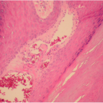 Fig. 3-B Microscopic section showing hyperkeratosis, papillomatosis, and acanthosis with dilated vascular papillae extending to the skin (hematoxylin and eosin stain, 30× magnification).
