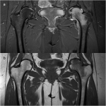 Fig. 1 Figs. 1-A and 1-B: MRI of the pelvis at first presentation. Fig. 1-A The short tau inversion recovery (STIR) coronal image demonstrates increased signal intensity within the left femoral head and neck, in accordance with marrow edema. There is also a small left hip effusion. Fig. 1-B The corresponding T1-weighted coronal image demonstrates low signal intensity in the left femoral head and neck, in accordance with marrow edema.
