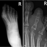Fig. 1 Figs. 1-A and 1-B: Radiographs. Fig. 1-A Initial radiograph of the right foot demonstrates a 7-mm lytic focus in the proximal phalanx of the third toe. Fig. 1-B Six months later, a dedicated radiograph of the right third toe shows a more permeative lytic lesion in the proximal phalanx, with the surrounding soft-tissue shadow of a soft-tissue mass abutting the second and fourth toes.
