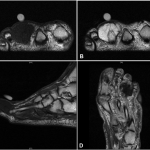 Fig. 2 MRI demonstrates a mass of the proximal phalanx of the right third toe with a circumferential soft-tissue mass that was hypointense to muscle on T1-weighted sequences (Fig. 2-A) and hyperintense to muscle on fat-saturated T2-weighted sequences (Fig. 2-B). The normal marrow signal of the third proximal phalanx was entirely replaced by tumor (Fig. 2-C). Minimal heterogeneous enhancement was noted with gadolinium (Fig. 2-D).
