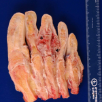 Fig. 3 Gross pathological specimen after transmetatarsal amputation, showing cortical destruction and soft-tissue extension, as well as invasion of the middle phalanx and the metatarsal-phalangeal joint of the third ray. The photograph denotes areas of gelatinous (*) and cystic (arrow) features.
