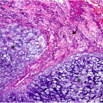 Fig. 4 Photomicrograph of the resected specimen demonstrating juxtaposition of a Grade-II chondrosarcoma (*) with an osteoid-producing high-grade spindle-cell component (arrow), which confirmed the diagnosis of dedifferentiated chondrosarcoma (hematoxylin and eosin stain, medium power).
