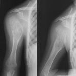 Fig. 1 Anteroposterior (Fig. 1-A) and lateral (Fig. 1-B) radiographs of the proximal part of the right humerus at the initial visit to a local hospital. The tumor is a geographic, mildly expansile, lytic lesion with mild cortical thinning. Intratumoral calcification is evident.
