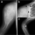 Fig. 2 A radiograph of the proximal part of the right humerus demonstrates an expansile lytic lesion with thinning of the cortex and intratumoral calcification (Fig. 2-A). Compared with the radiographs that were obtained six months previously (Fig. 1), the lesion had enlarged markedly. Osteolytic lesions with slight cortical thinning are also evident in the right scapula (Fig. 2-B) and radius (Fig. 2-C).
