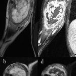 Fig. 3 MRI demonstrated a lobulated lesion with intermediate signal intensity on the T1-weighted image and high signal intensity on the T2-weighted images (Figs. 3-A and 3-B). Intense septal and peripheral rimlike contrast enhancement is noted (Figs. 3-C and 3-D).

