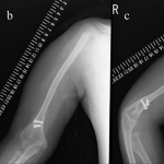 Fig. 5 Radiographs immediately after surgery (Fig. 5-A) and five years postoperatively (Figs. 5-B and 5-C).
