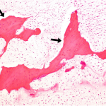 Fig. 6 The tumor showed increased cellularity and myxoid change. Preexisting lamellar bone trabeculae (arrows) were entrapped within the mass, indicating permeative tumor growth that is diagnostic of chondrosarcoma (hematoxylin and eosin stain, original magnification ×100).

